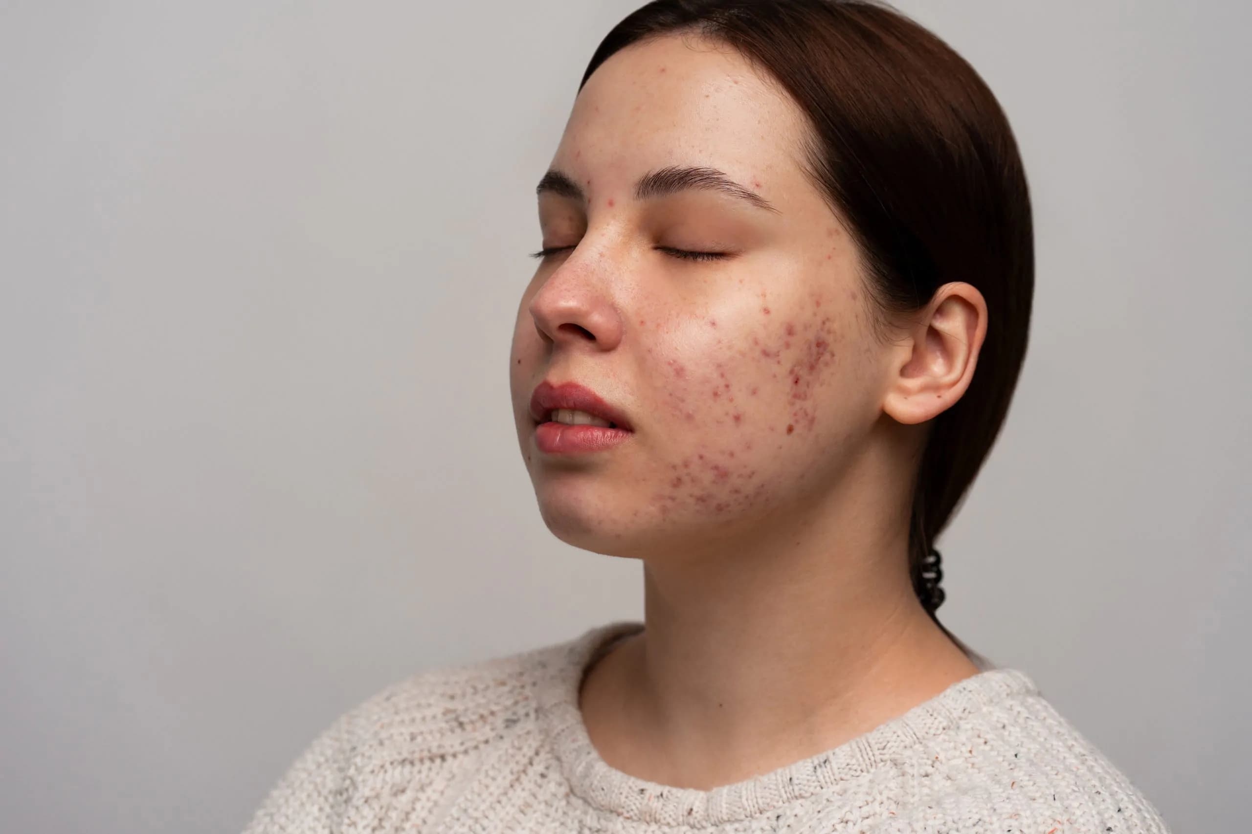 Acne Scar Treatment