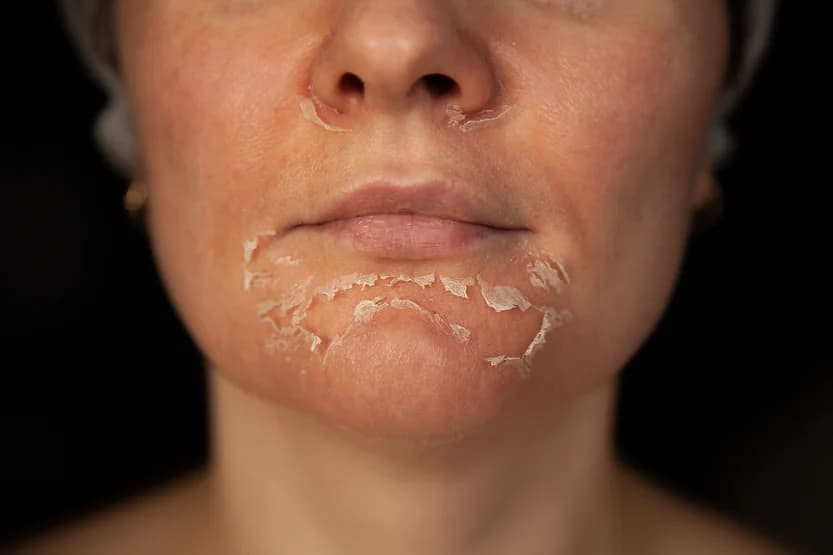 Chemical Peeling
